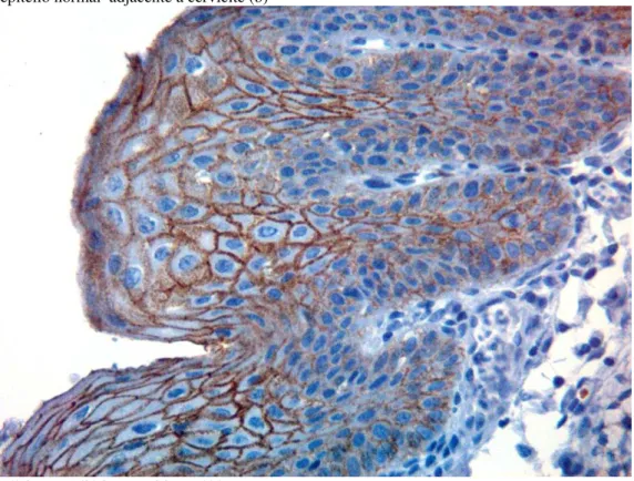 Tabela 4 - Imunoexpressão da Caderina-E na Lesão Intraepitelial Escamosa de Baixo Grau (LIEBG) por região  histológica e na espessura epitelial 