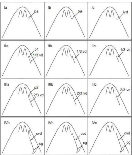 Figura  5.  Escala  de  desenvolvimento  do  imposex  (IDI)  proposta  para  Stramonita  haemastoma,  detalhando rotas alternativas do desenvolvimento do pênis