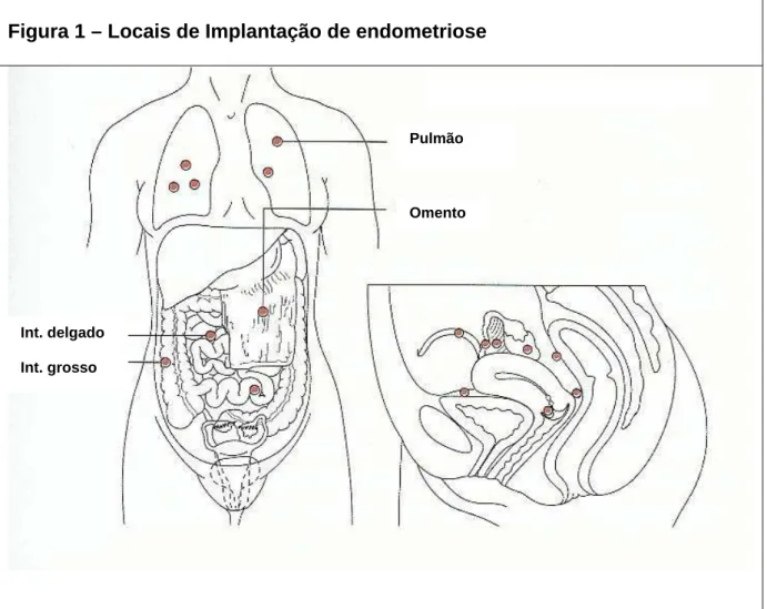 Figura 1 – Locais de Implantação de endometriose 