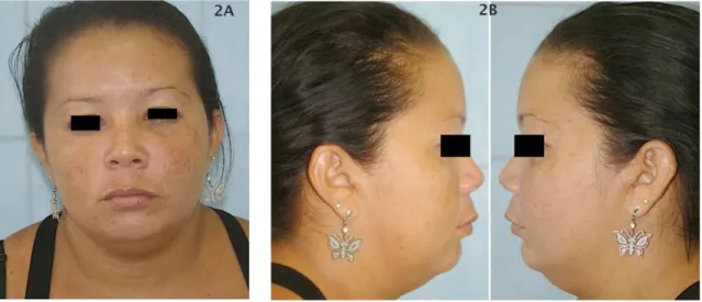 Figure  3  –  En�o�ontic treat�ent �as resu�e� using n�o�ontic  treat�ent  �as  resu�e�  using  c�lor�exi�ine  gel  as  irrigant  an�  lateral  con�ensation  tec�nique to fill t�e canals