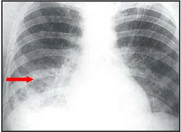 Figura  6  -  Radiografia  do  tórax,  com  infiltrado  intersticial  difuso,  com  predomínio  paracardíaco direito