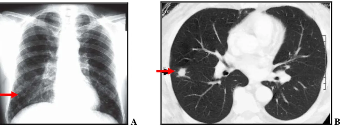 Figura 7 – A. Radiografia de tórax, demonstrando micronódulos difusamente distribuídos em ambos os pulmões; 
