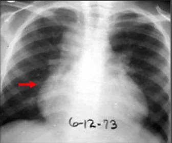 Figura 9 - Histoplasmose pulmonar aguda com pericardite. A sombra cardíaca está aumentada  pela efusão pericárdica, com linfadenopatia paratraqueal