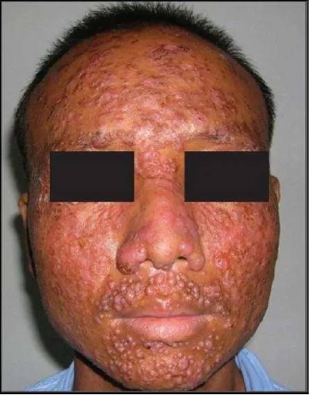 Figura 10  –  Nódulos, placas e lesões semelhantes a molusco na face em indivíduo do sexo masculino  com AIDS 