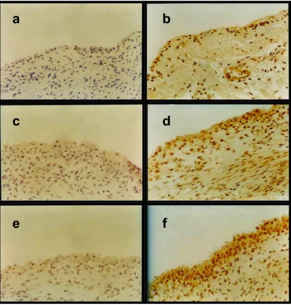 Figura 7: Fotomicrografia de tecidos sinoviais marcado por imunohistoquímica para a iNOS