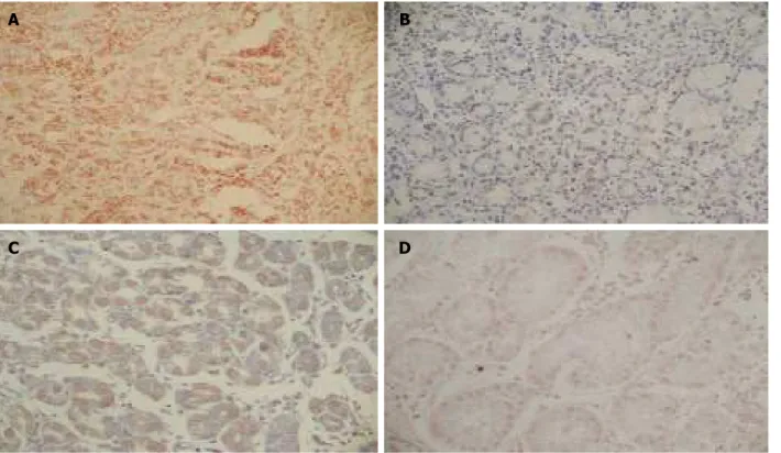 Figure 1  A: In situ hybridization detection of EBV RNA in gastric cancer (X400); B: Bcl-2 expression in gastric carcinoma (× 400); C: Bax expression in gastric carcinoma  (×400); D: c-Myc expression in gastric carcinoma (× 400).