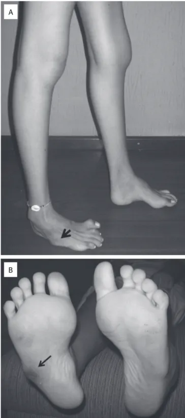Figura 1. Paciente com DCMT. (A) Paciente com instabilidade articular em  tornozelo. Note os dedos fletidos (cabeça de seta) e aumento do arco  plantar