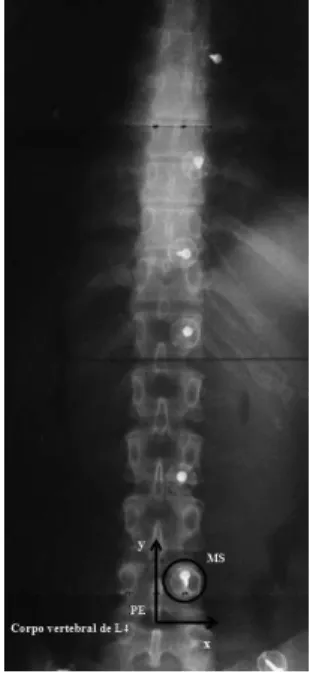 Figura 1.  Imagem radiológica da coluna vertebral no plano frontal, em decúbito 