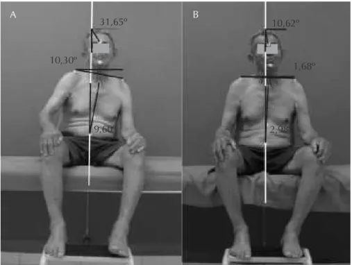 Figura 2    Ângulos (º) da inclinação da cabeça, ombros e tronco antes e depois do programa de fisioterapia aquática