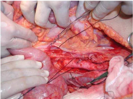 Figura 1 – Aorta, veia cava e veia mesentérica inferior dissecadas durante a captação de órgãos