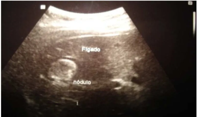 FIGURA 4 – Imagem de ultrassonografia demonstrando um nódulo hepático.  