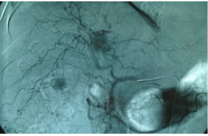 FIGURA 8 – Imagem de cateter seletivo na artéria hepática durante uma Quimioembolização