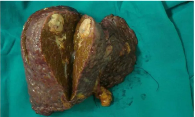 FIGURA 9 - Imagem de um fígado explantado com um carcinoma hepatocelular 