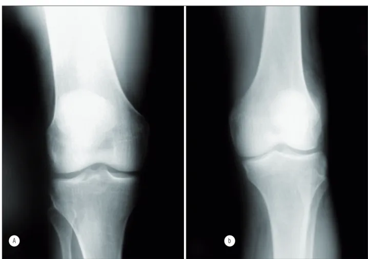 Figura 2  - Radiografias em incidência anteroposterior da articulação do joelho no membro intacto de dois indivíduos  amputados 