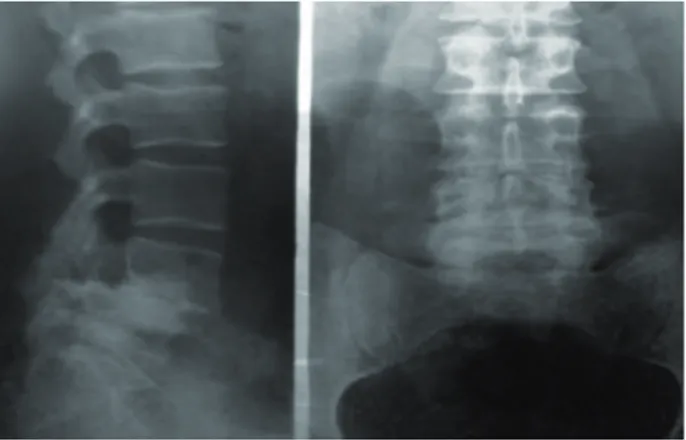 Figura 1  - Radiografia em anteroposterior e perfil demons- demons-trando espondilolistese traumática de L4-L5 em  grau 2, realizada antes da intervenção com o  método Pilates em agosto de 2010
