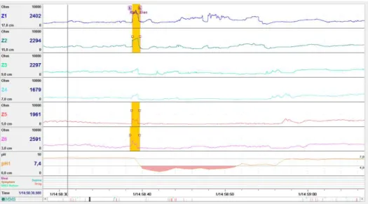 FIGURA 9  –  Imagem de registro de refluxo de gasoso ácido à impedancio-pHmetria 