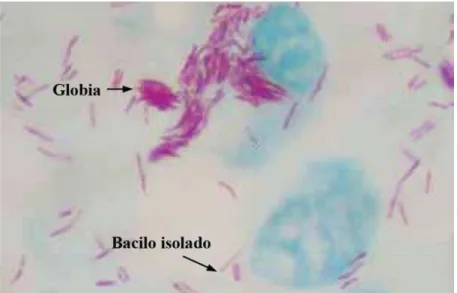 Figura 9 –Mycobacterium leprae visto em globia e isolados. (Ziehl-Neelsen 100x). 