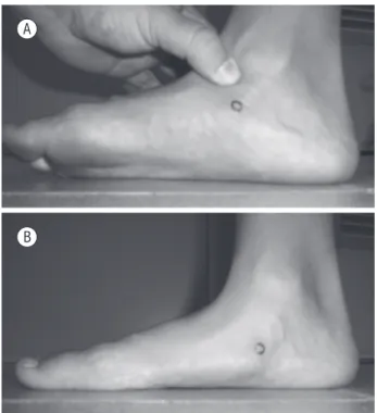 Figura 1  - Fotos ilustrativas do teste da queda do navicular.  A) Subtalar em neutro