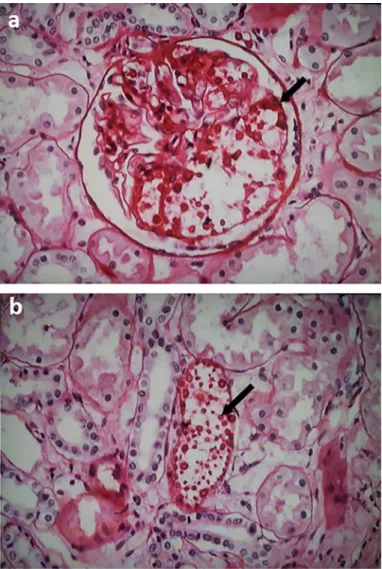 Fig. 1 - Main renal findings. (a) Renal biopsy showing numerous encapsulated yeast forms  (Cryptococcus sp.) in glomerulus, interstitium and in (b) renal tubule (black arrow)