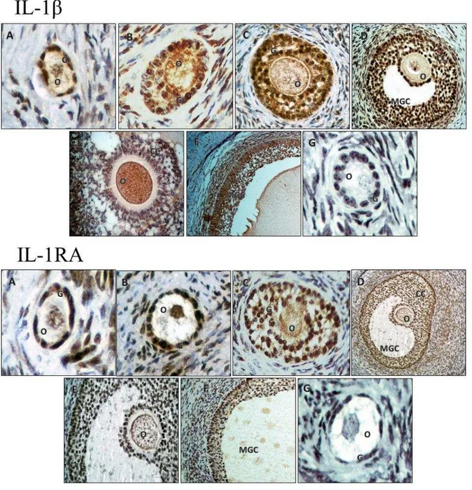 Figure  1A-G.  IL-1β  and  IL-1RA  immunoreactivity  in  different  follicular  categories