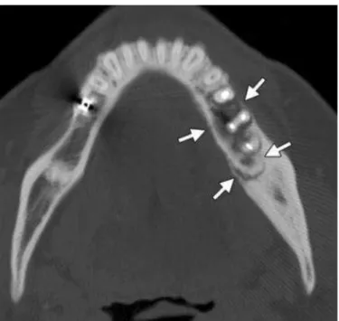 Figura 5: Aspecto imaginológico (tomografia computadorizada de feixe cônico, corte axial)  da OMB