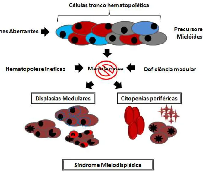 Figura 1: Representação esquemática da gênese das Síndromes Mielodisplásica. 