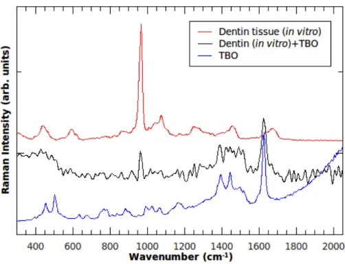 FIGURE  1.  Raman  spectra  recorded  from  the  photosensitizer-TBO;  in vitro  caries- caries-affected dentin and dentin sensitized by TBO