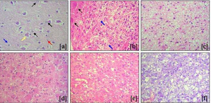 FIGURA 06 – Histopatologia dos tumores astrocíticos (HE, 400X). [a] Caso n o . 0.3 - Córtex Cerebral Não- Não-Tumoral: observam-se corpos celulares de neurônios piramidais, de formato triangular (seta amarela); astrócitos  normais, com núcleos grandes, arr