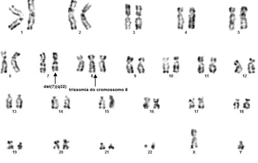 Figura  9:  Paciente  do  sexo  masculino  apresentando  cariótipo  alterado  47,XY,+8[6]/47,XY,del(7)(q32),+8[7]/46,XY[2]  de  prognóstico  desfavorável de acordo com  a classificação do IPSS (GREENBERG et al., 1997)