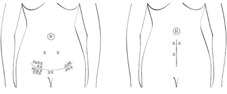 Figura 1.   Distribuição  de  locais  de  endometriomas  subcutâneos  quanto  à  cicatriz abdominal 