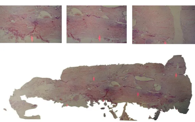 Figura 4.    Microfotografia de espécime de lesão endometriótica subcutânea,  após  utilização  do  software  Image  Composite  Editor  para  composição de várias imagens em amostra única