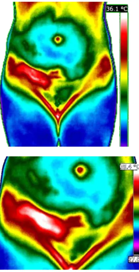 Figura 7.   Aspecto  de  assimetria  térmica  observada  em  um  caso  de  endometrioma de cicatriz de ângulo direito da ferida 