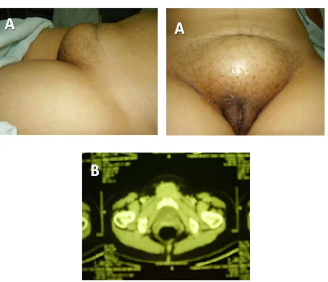 Figura 11.  Aspecto  clínico  e  da  ressonância  nuclear  magnética  de  endometriose de parede abdominal oriunda de cicatriz de cesárea  invadindo a vulva 