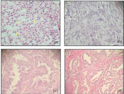 FIGURA  7  –  Histopatologia  dos  adenocarcinomas  gástricos  do  tipo  difuso  [a,  b]  e  intestinal  [c,  d]  (HE,  400X)