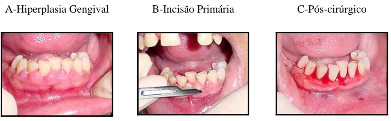 Figura 1: Remoção cirúrgica do aumento gengival em pacientes sem aparelho ortodôntico 