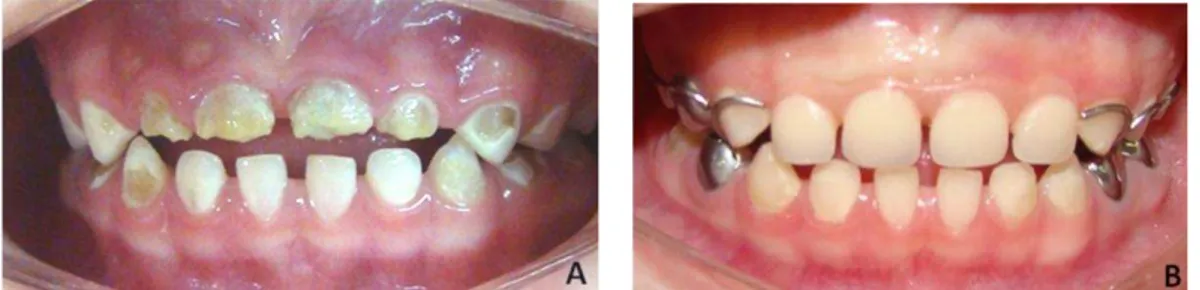 Figura 6: Tratamento odontológico realizado em um dos participantes do estudo. 