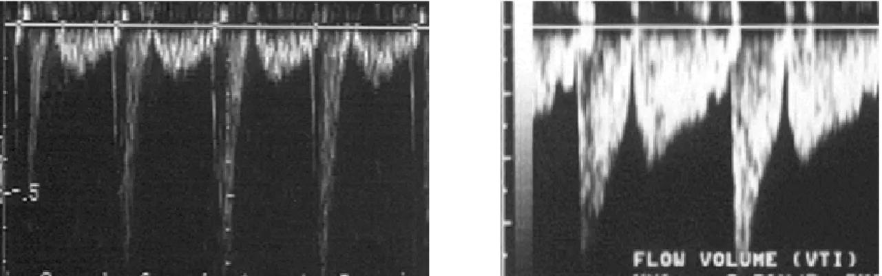 Figura 2 - Variáveis obtidas com a imagem espectral do Doppler pulsátil à esquerda e bidimensional à direita