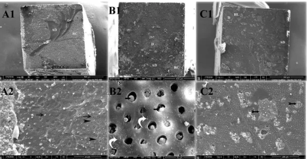 Figure 2 - The 24 h SEM images of all three groups showed representative mixed failures; 2A1-2) SB-CT,  adhesive failure at the top of HL was observed; 2B1-2) The portions on fractured surface of SB- β 1; and  2B1-2)  SB- β 2    where  dentin  was  exposed