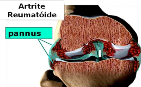 Figura  4 -  O  pannus  (tecido  inflamatório  granulomatoso  neoformado  proveniente  da  membrana) na Artrite Reumatóide