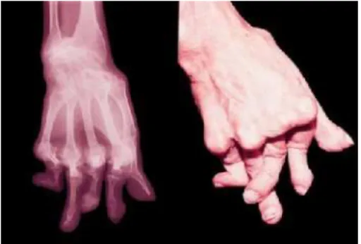 Figura 6 – Radiografia e característica clínica do acometimento das mãos de  paciente com Artrite Reumatóide