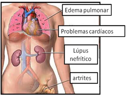 Figura 8 – Patologia sistêmicas no Lúpus Eritematoso Sistêmico