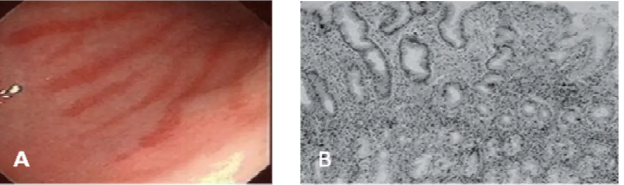 Figura  4:  Gastrite  crônica  não  atrófica:  A)  Aspecto  endoscópico  gastrite  crônica  não  atrófica