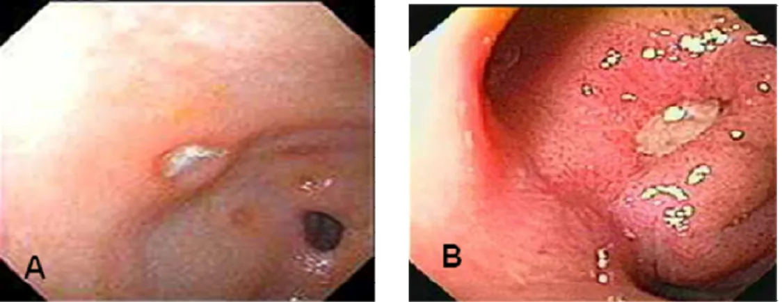 Figura 13: Microfotografia de úlcera gástrica A) Úlcera na região pré-pilorica, B) Úlcera no duodeno.