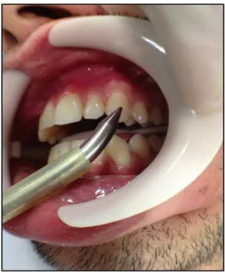 Figura 24: Teste elétrico de vitalidade pulpar sendo realizado no dente canino superior esquerdo.