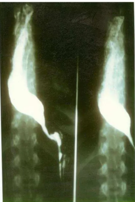 Figura 1: Radiografia contrastada do esôfago: megaesôfago grau II 