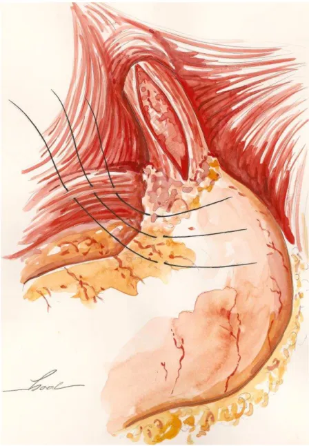 Figura 4.  Esofagocardiomiotomia  de  Heller  seguida  da fixação do  cárdia  ao ligamento arqueado (cardiopexia de Hill)