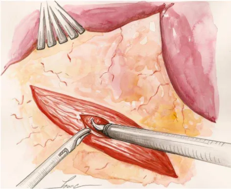 Figura  8.  Início  da  miotomia  laparoscópica:  após  abertura  da  membrana  freno-esofagiana, secção das fibras musculares longitudinais do esôfago