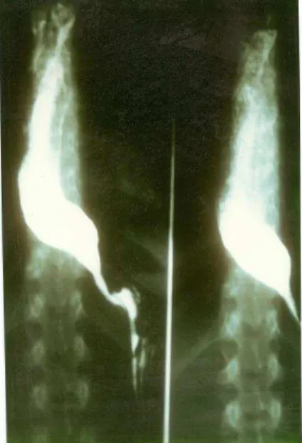 Figura 22.  Exame  contrastado  do  esôfago  em  um  paciente  portador  de  megaesôfago grau II no período pré e pós-operatório