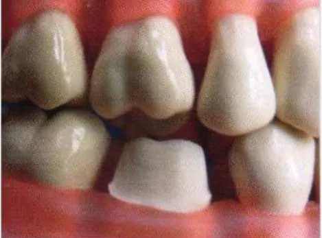 Fig. B1 - Preparo do dente a 