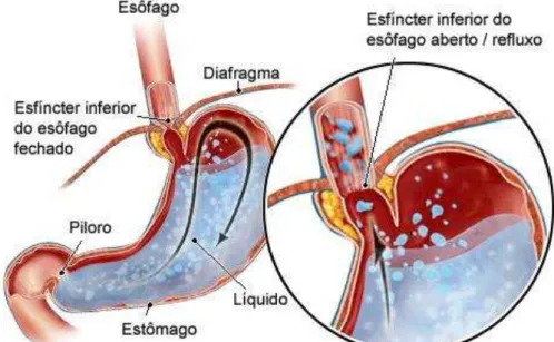Figura 5. Refluxo Gastroesofágico. Fonte: www.medicinanet.com.br 